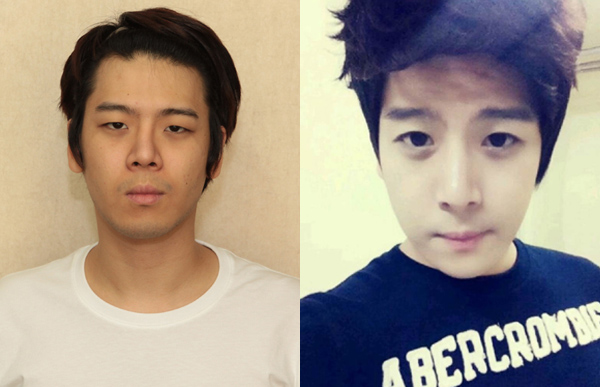 Korean_plastic_surgery_before_and_after_13
