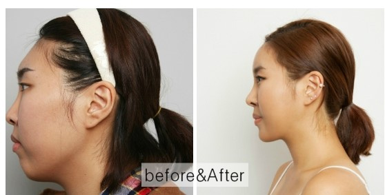 Korean_plastic_surgery_before_and_after_17