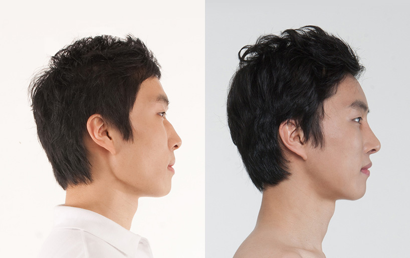 Korean_plastic_surgery_before_and_after_22