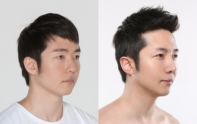 Korean_plastic_surgery_before_and_after_27