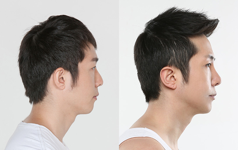 Korean_plastic_surgery_before_and_after_28