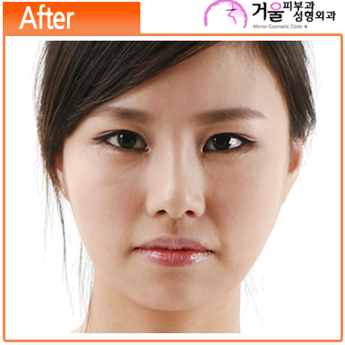 Korean_plastic_surgery_before_and_after_3