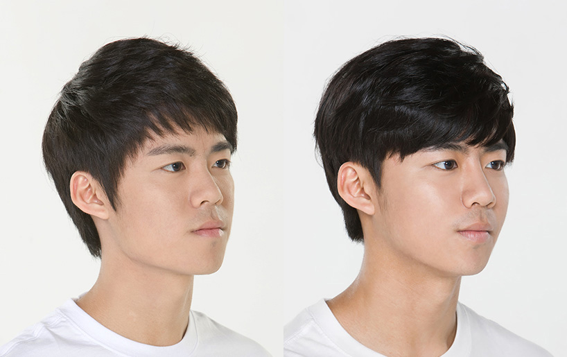 Korean_plastic_surgery_before_and_after_30