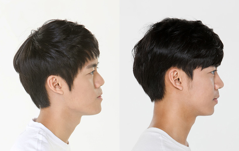 Korean_plastic_surgery_before_and_after_31
