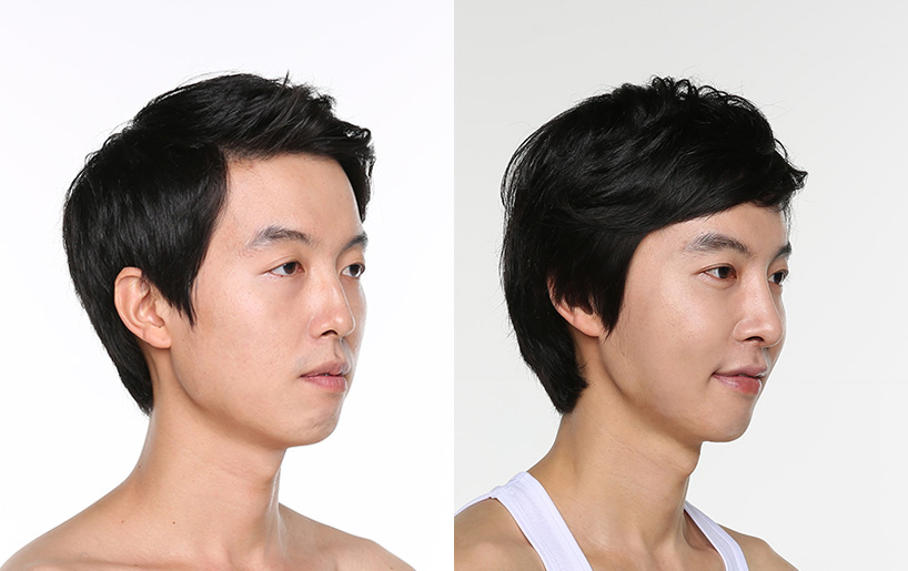 Korean_plastic_surgery_before_and_after_38