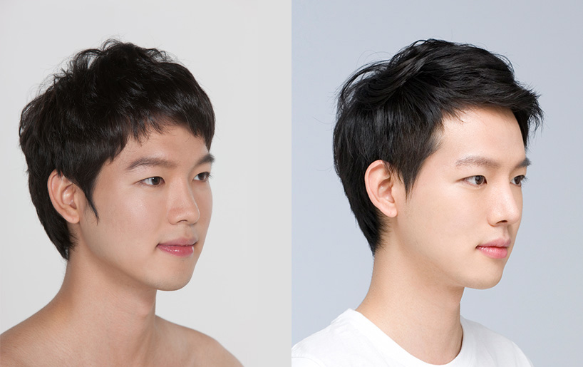 Korean_plastic_surgery_before_and_after_41