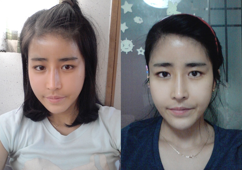 Korean_plastic_surgery_before_and_after_7