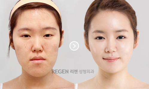 Korean_plastic_surgery_before_and_after_9