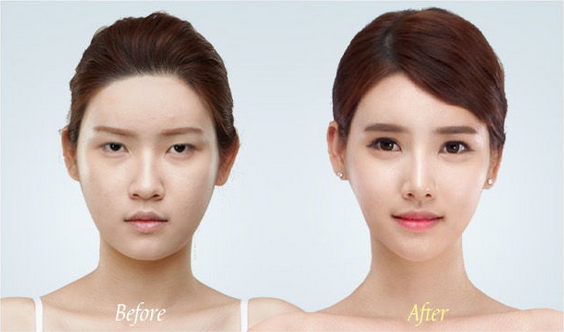 Korean_plastic_surgery_before_and_after_9