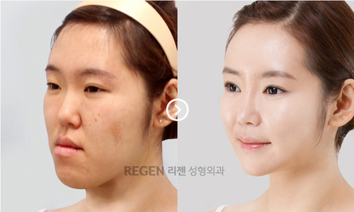 Korean_plastic_surgery_before_and_after_10