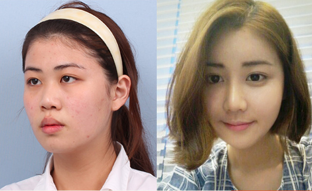 Korean_plastic_surgery_before_and_after_11