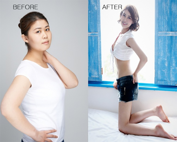 Korean_plastic_surgery_before_and_after_12
