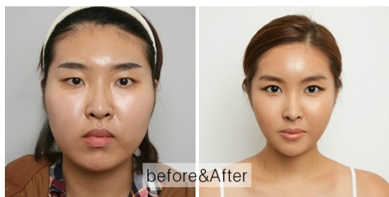 Korean_plastic_surgery_before_and_after_16