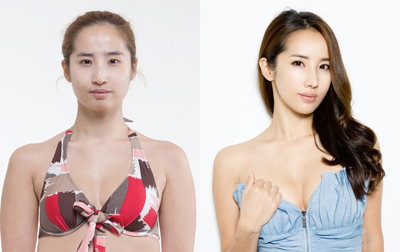 Korean_plastic_surgery_before_and_after_18