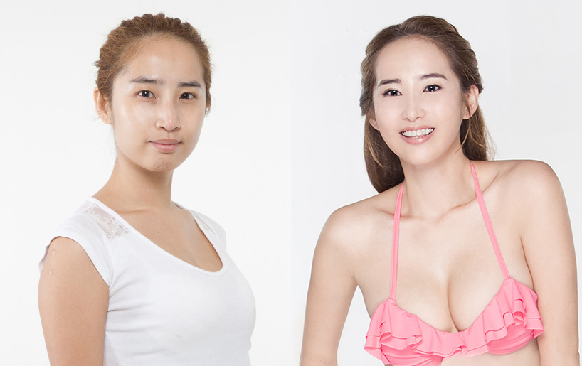 Korean_plastic_surgery_before_and_after_19