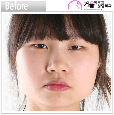 Korean_plastic_surgery_before_and_after_2