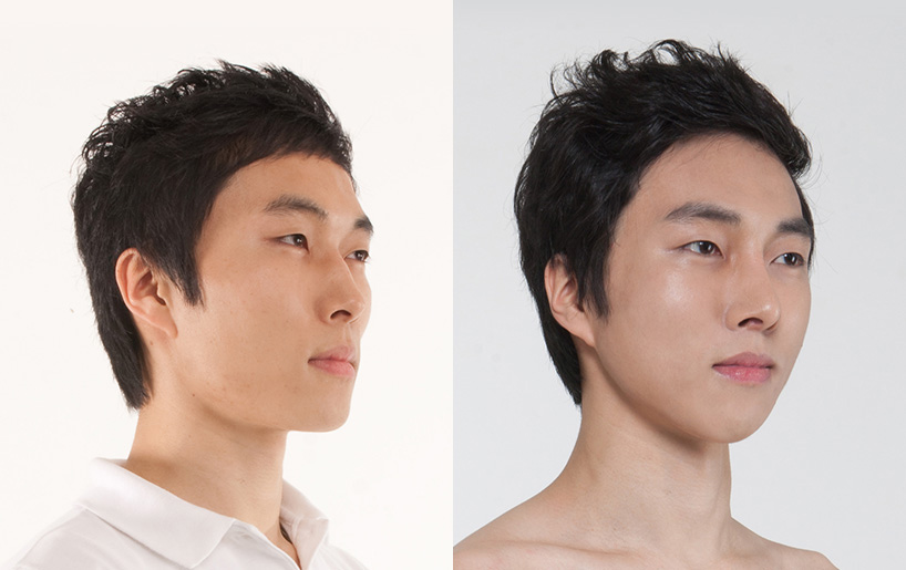 Korean_plastic_surgery_before_and_after_21