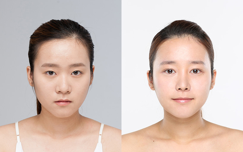 Korean_plastic_surgery_before_and_after_32