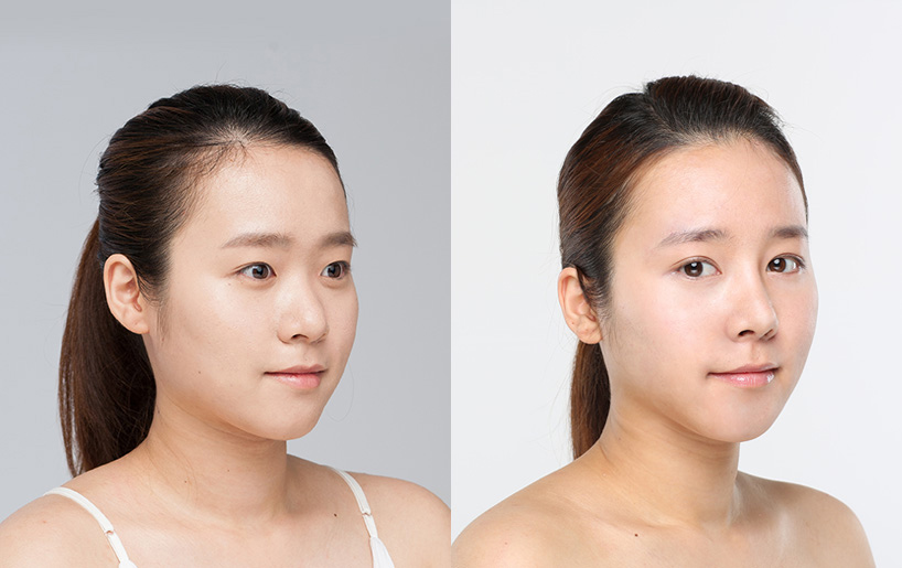 Korean_plastic_surgery_before_and_after_33