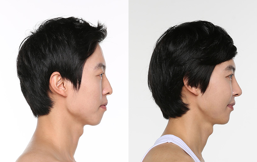 Korean_plastic_surgery_before_and_after_39
