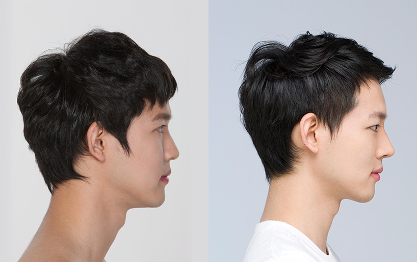 Korean_plastic_surgery_before_and_after_42