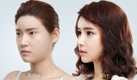 Korean_plastic_surgery_before_and_after_8